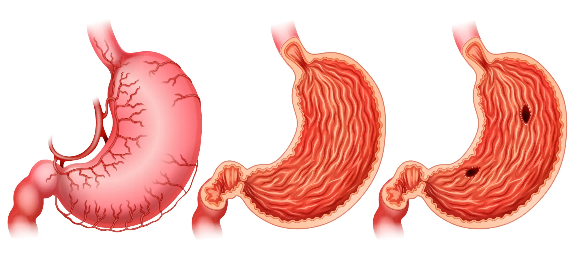 Ilustração Úlcera gástrica: Causas e tratamentos